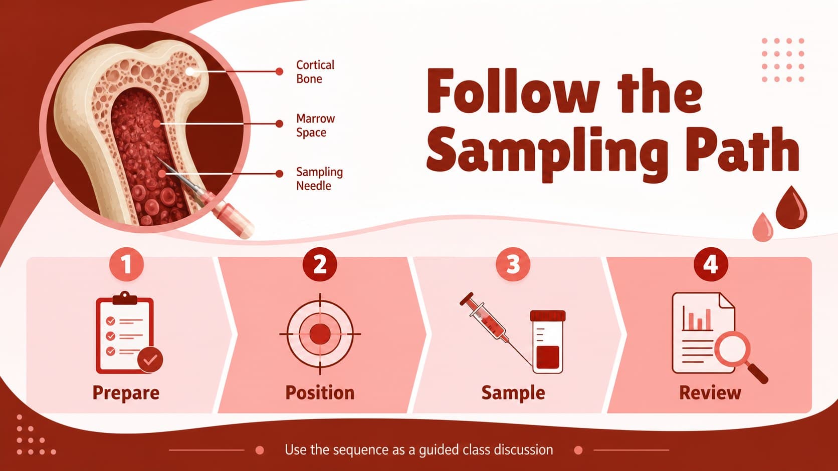 Clinical teaching slide mapping the main marrow sampling stages with illustrated callouts and red infographic accents.