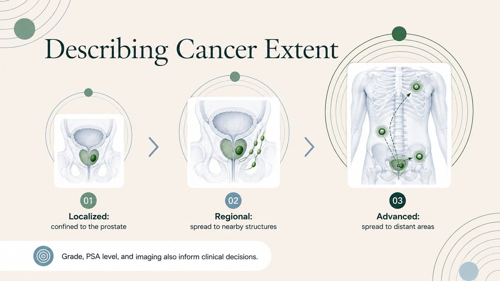 Prostate cancer stages overview with localized, regional, and advanced disease categories.