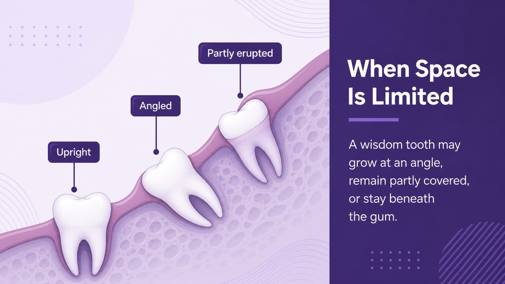 Impacted molar slide explaining how limited space can affect wisdom tooth direction.