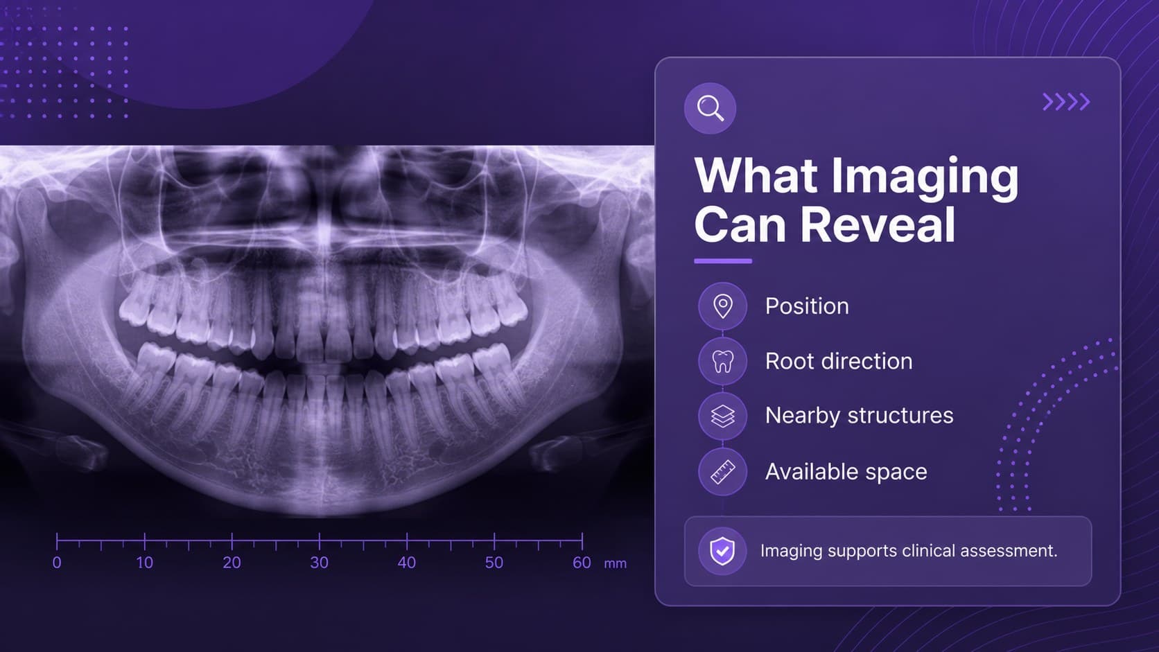 Wisdom tooth imaging slide with a radiograph frame and concise diagnostic discussion points.